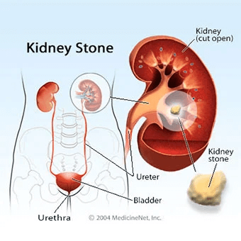 Kidney-stones